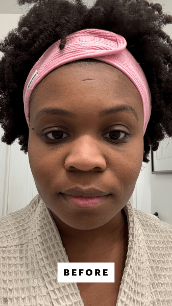 Cruel before applying the Shani Darden Triple Acid Signature Peel